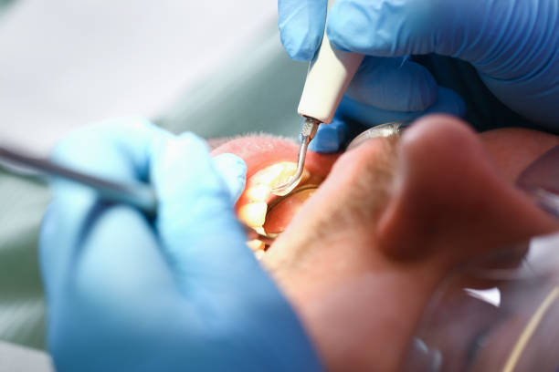 Best Emergency Dental Extractions in Riverside, OH