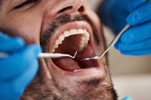 Best Emergency Dentist for Lost Fillings or Crowns in Riverside, OH